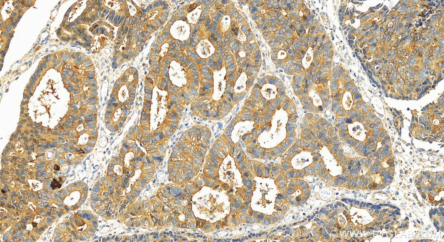 IHC staining of human stomach cancer using 29403-1-AP