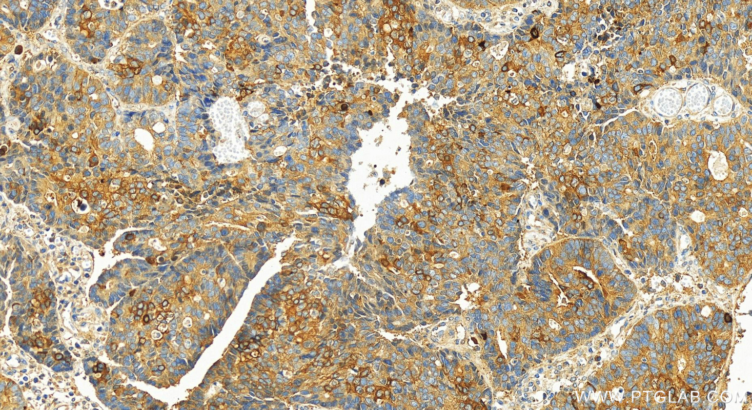 IHC staining of human stomach cancer using 29403-1-AP