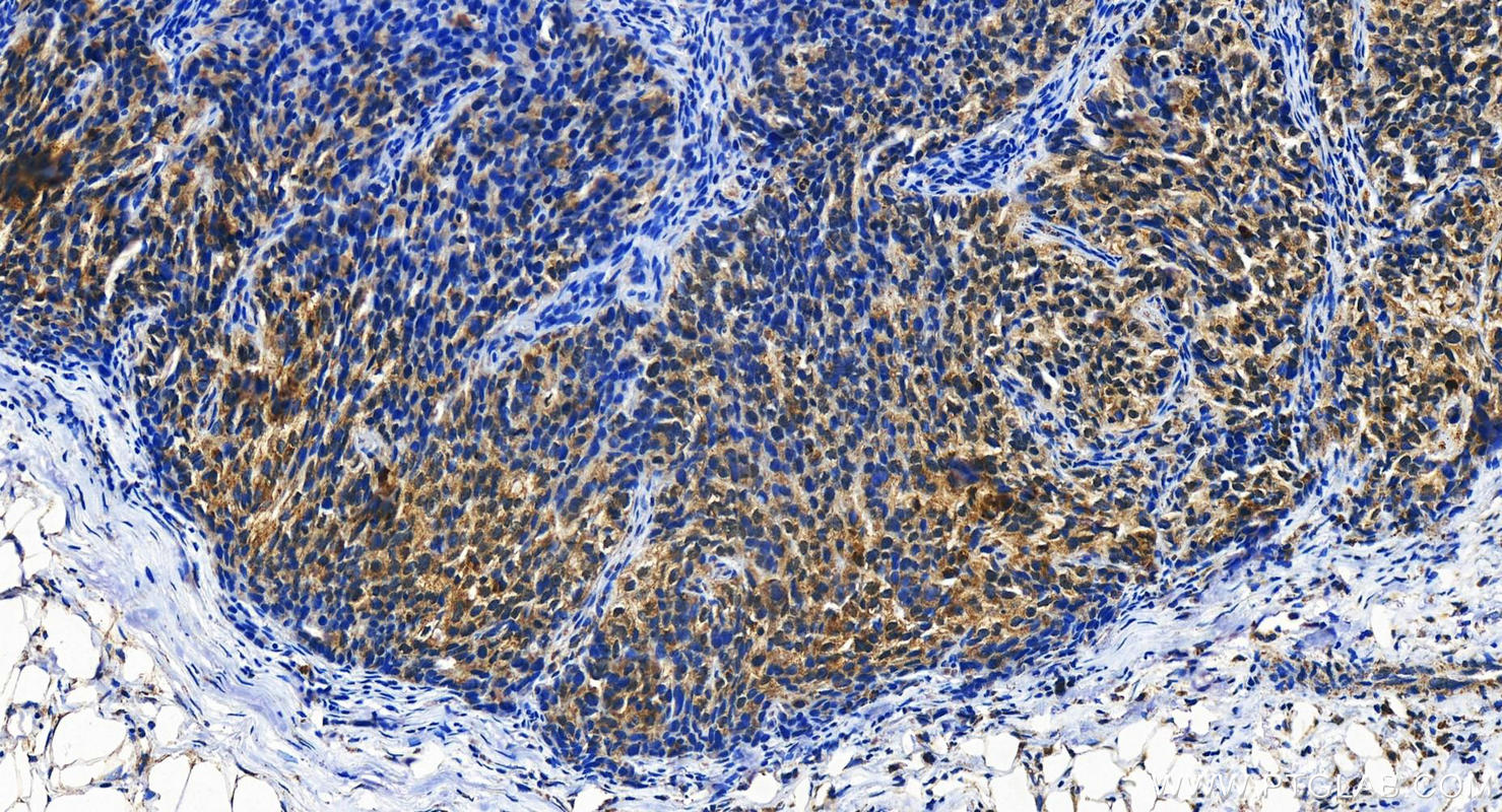 IHC staining of human ovary cancer using 19018-1-AP