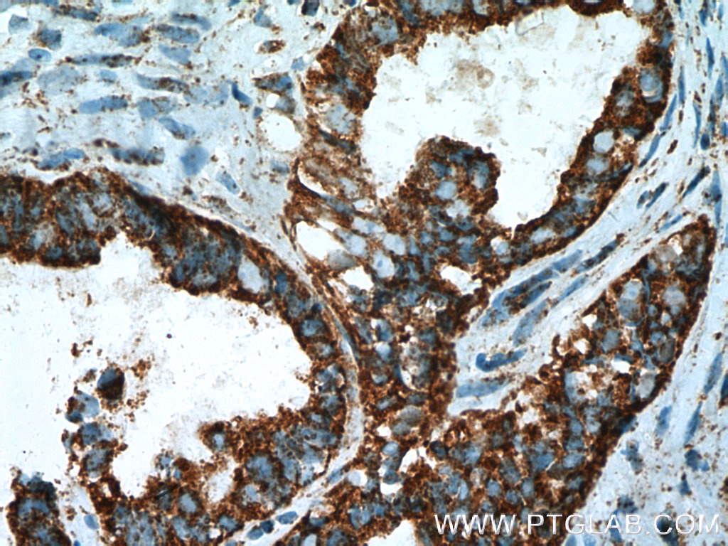 IHC staining of human ovary tumor using 11568-1-AP