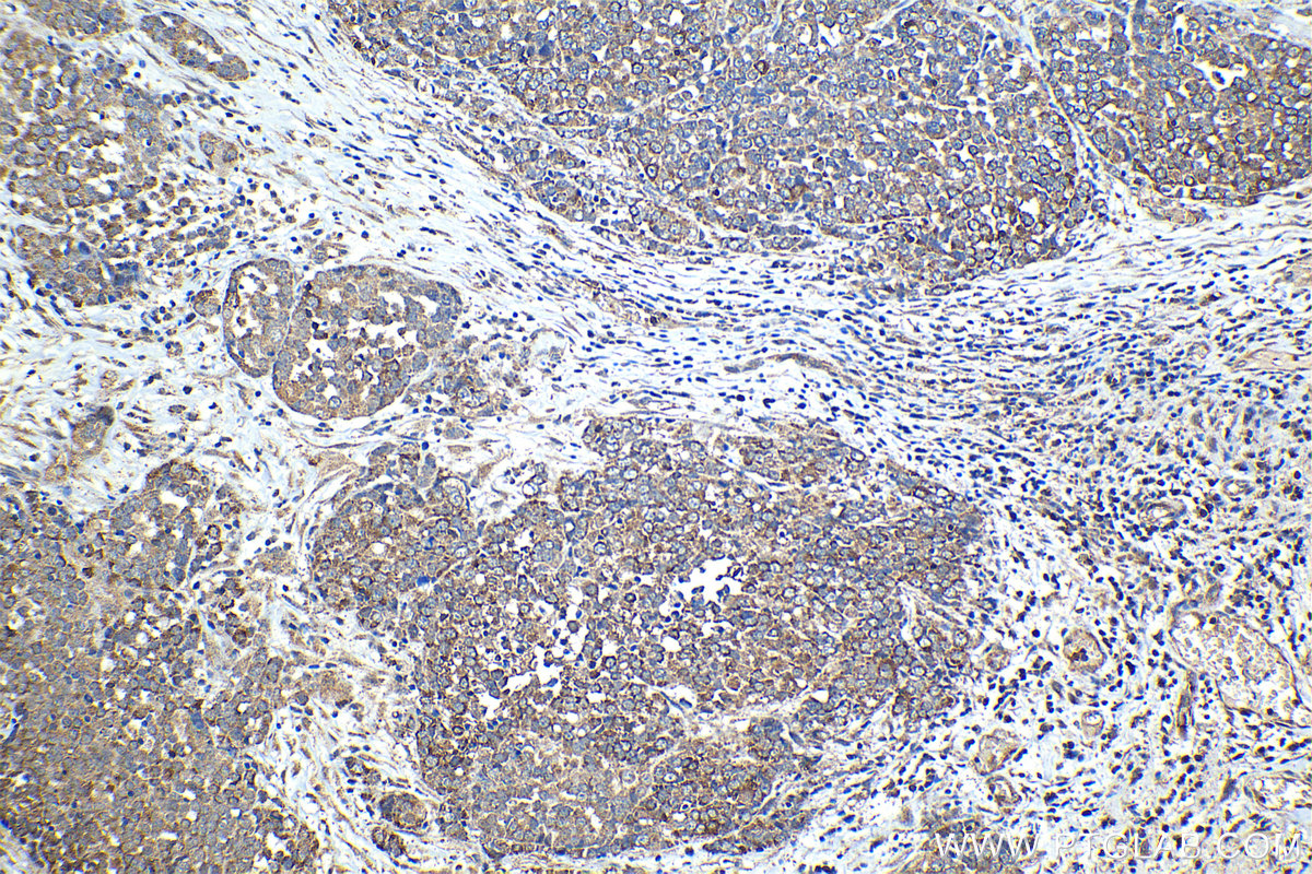 IHC staining of human ovary tumor using 10452-1-AP