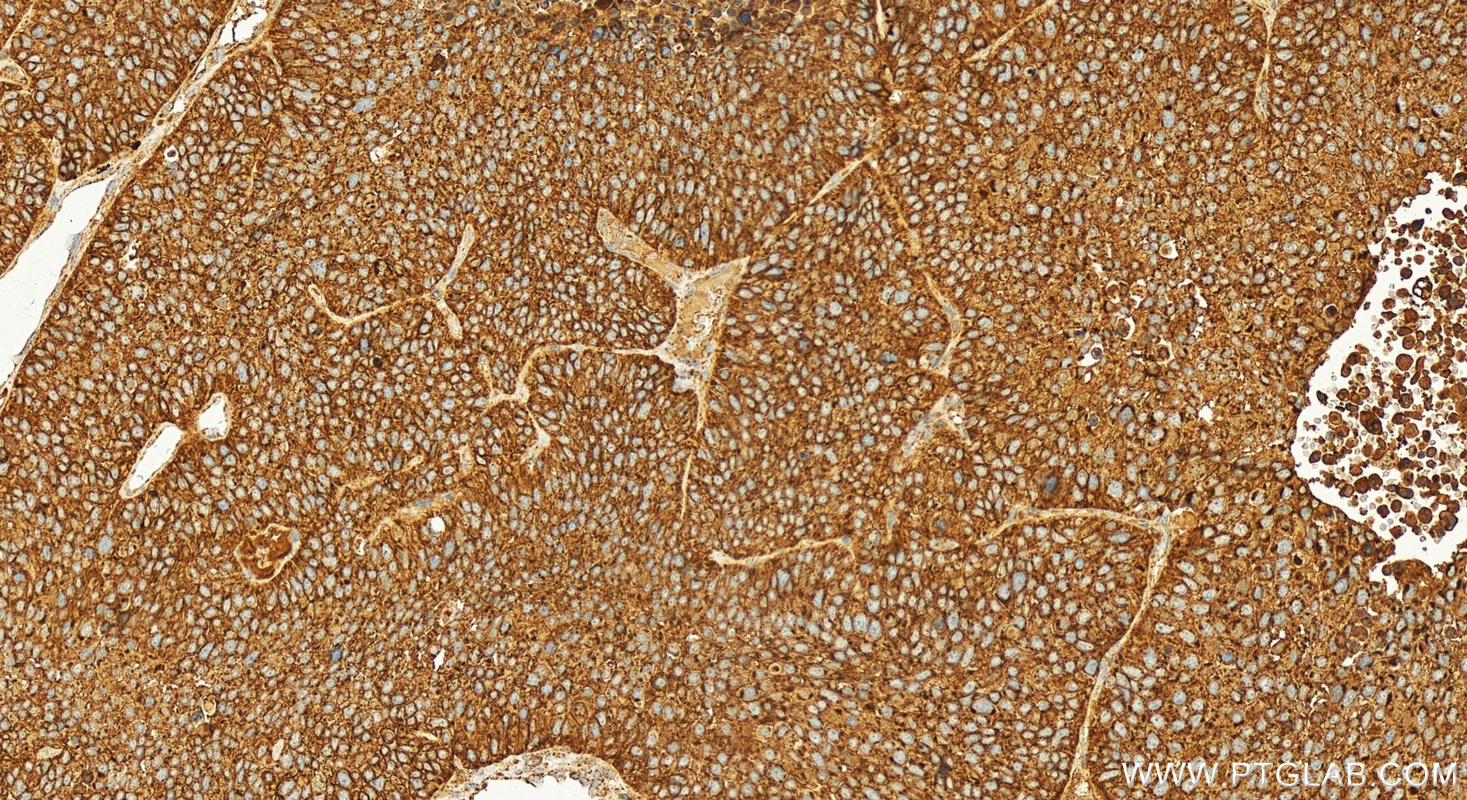 IHC staining of human lung squamous cell carcinoma using 29942-1-AP