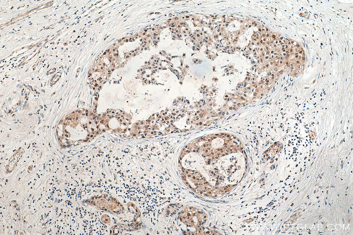 IHC staining of human breast cancer using 17742-1-AP