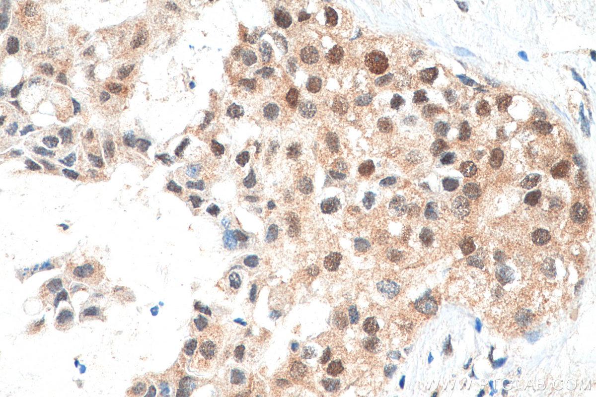 IHC staining of human breast cancer using 17742-1-AP