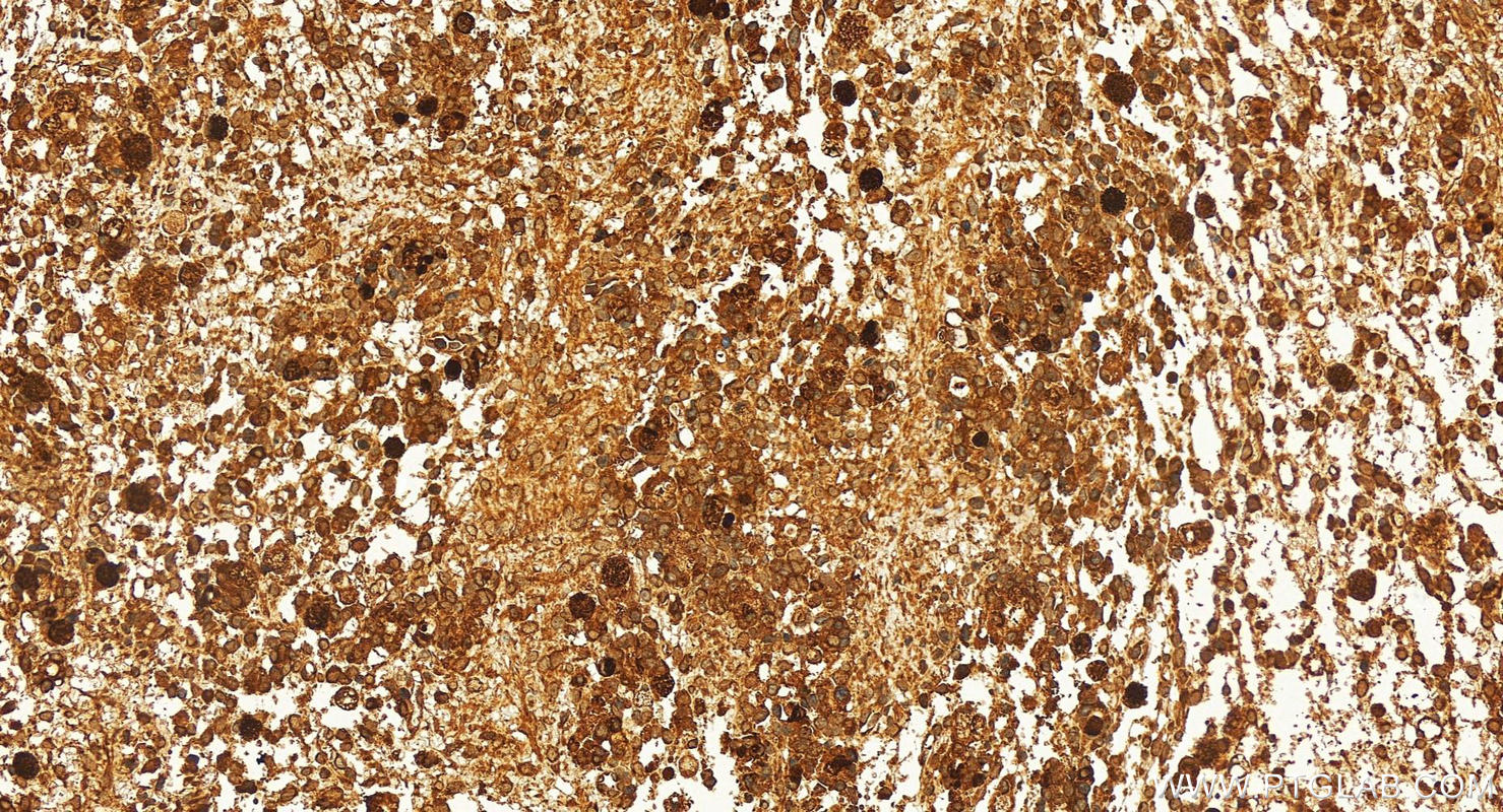 IHC staining of human ovary cancer using 11963-1-AP