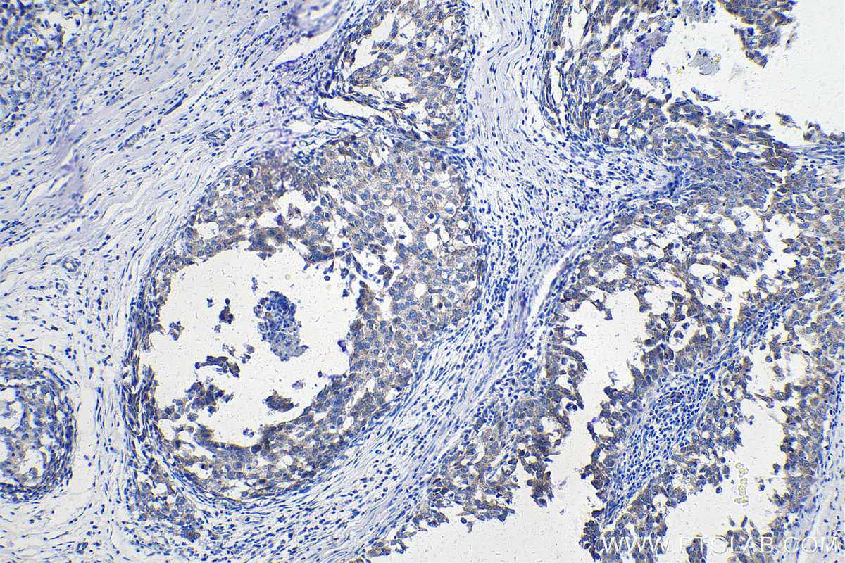 IHC staining of human breast cancer using 15360-1-AP