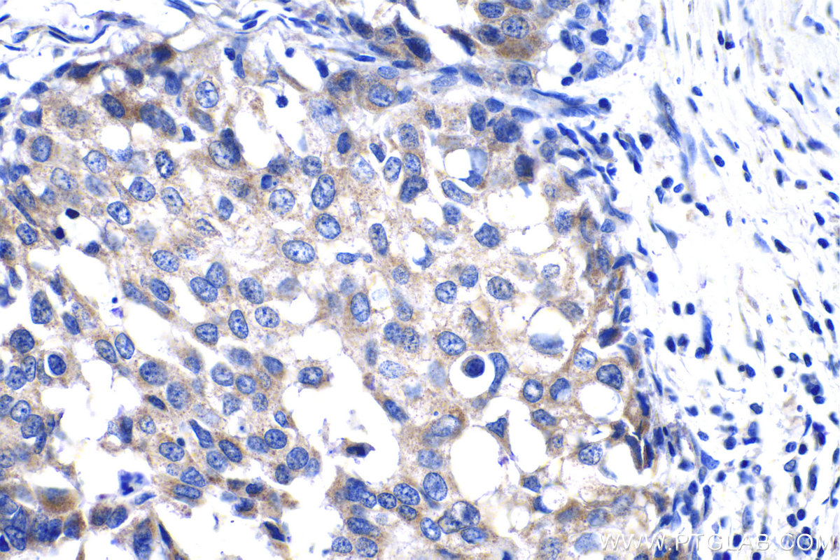 IHC staining of human breast cancer using 15360-1-AP