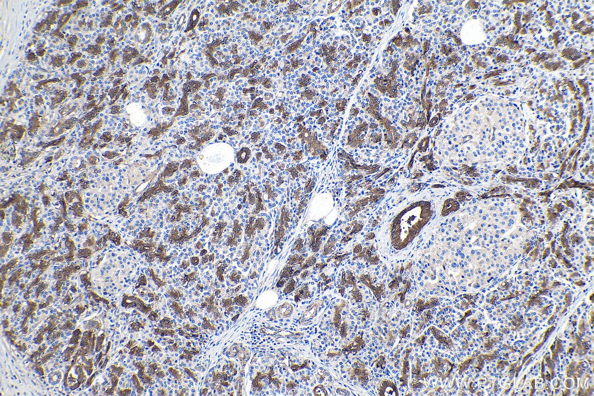 IHC staining of human pancreas cancer using 15360-1-AP