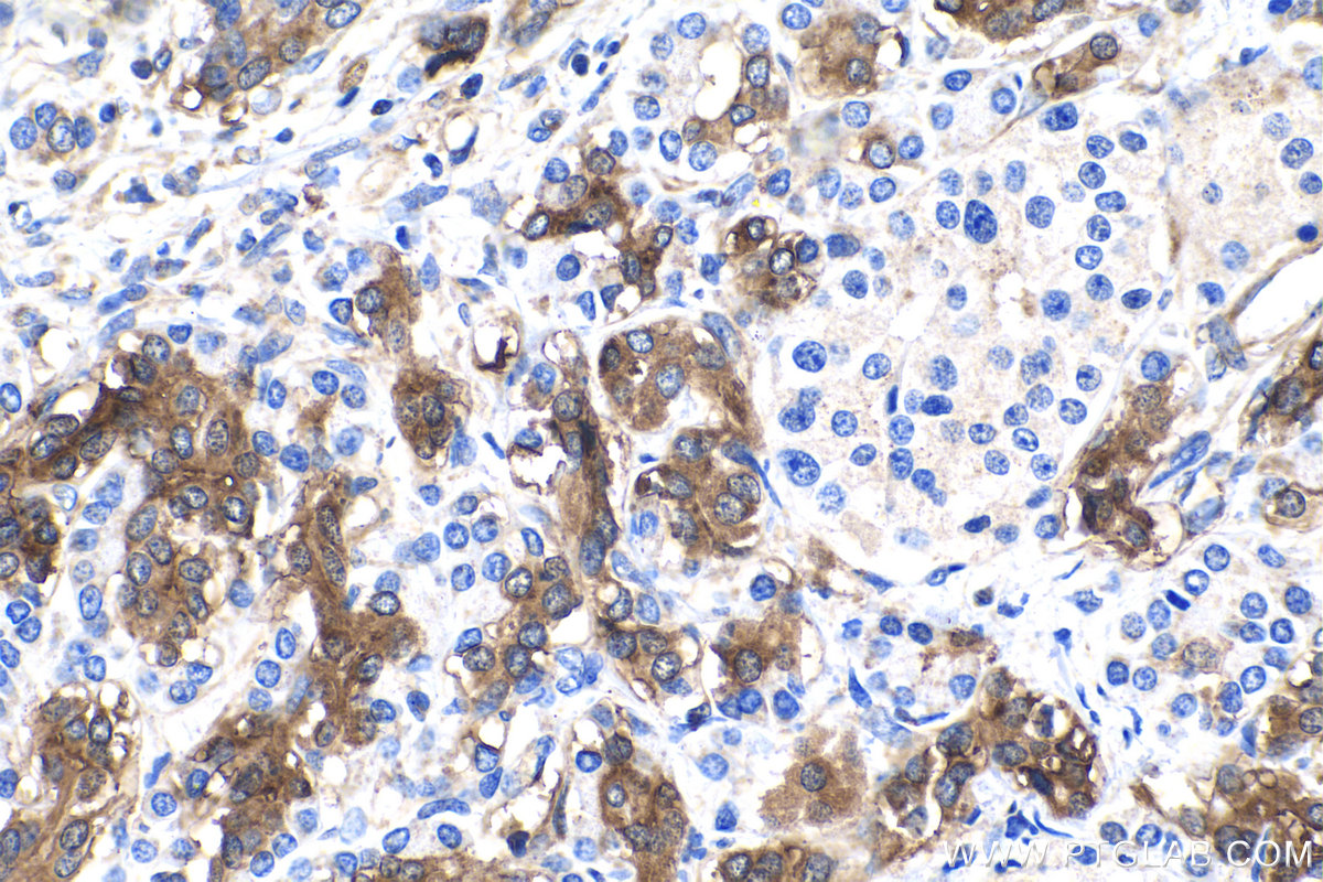 IHC staining of human pancreas cancer using 15360-1-AP