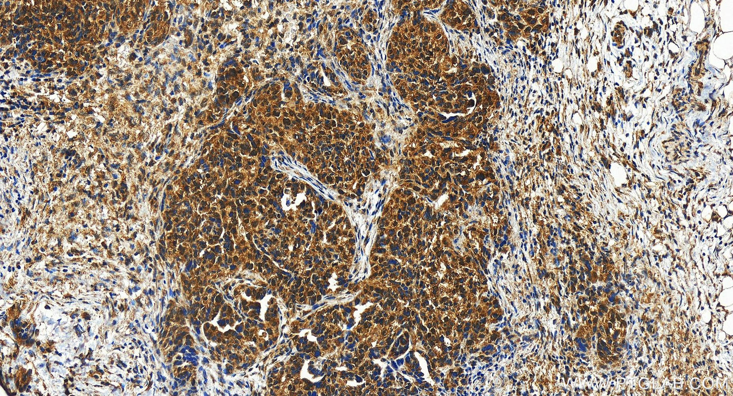 IHC staining of human ovary cancer using 22088-1-AP