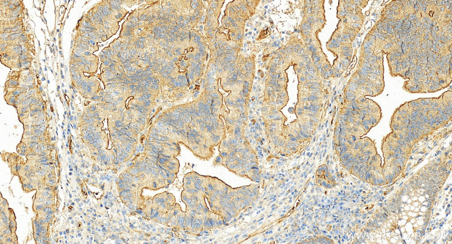 IHC staining of human colon cancer using 10909-1-AP