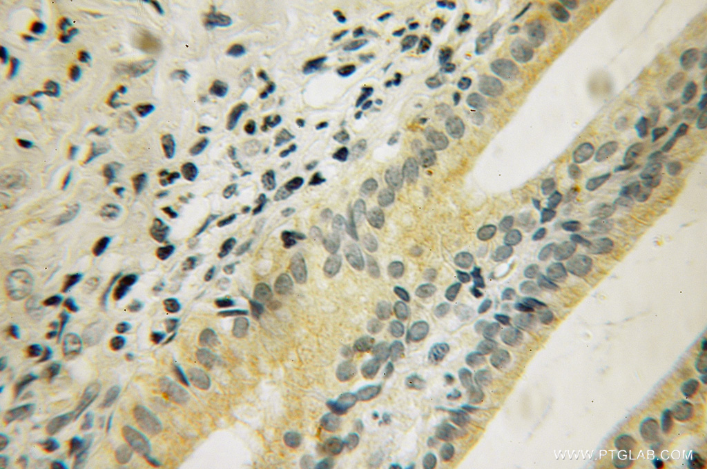 IHC staining of human pancreas cancer using 12924-1-AP