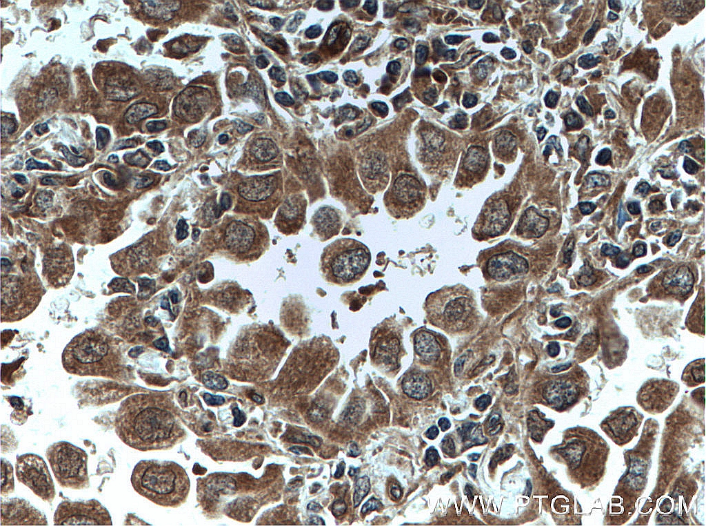 IHC staining of human lung cancer using 51005-2-AP