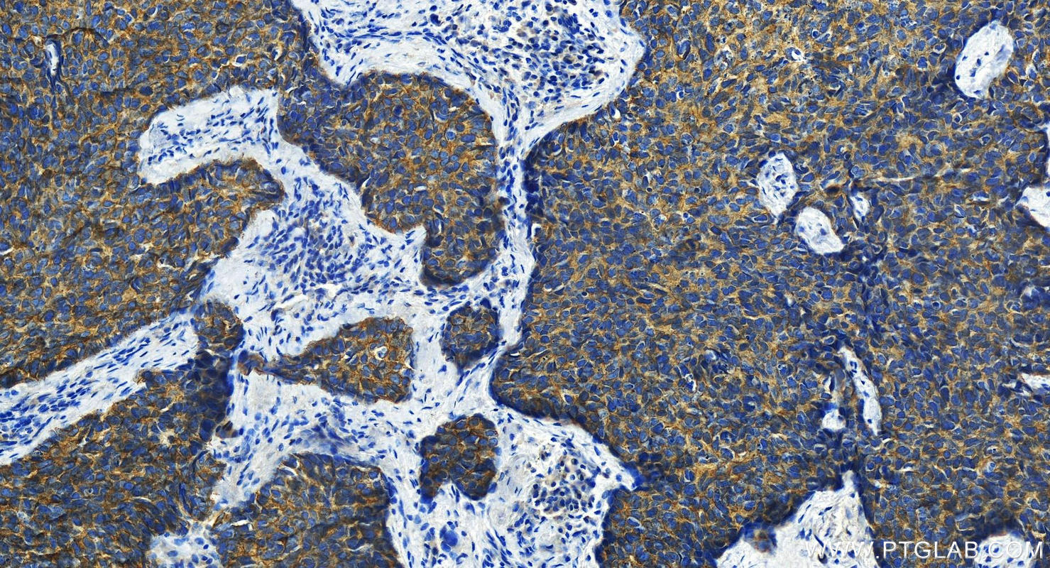 IHC staining of human bowen disease using 25318-1-AP