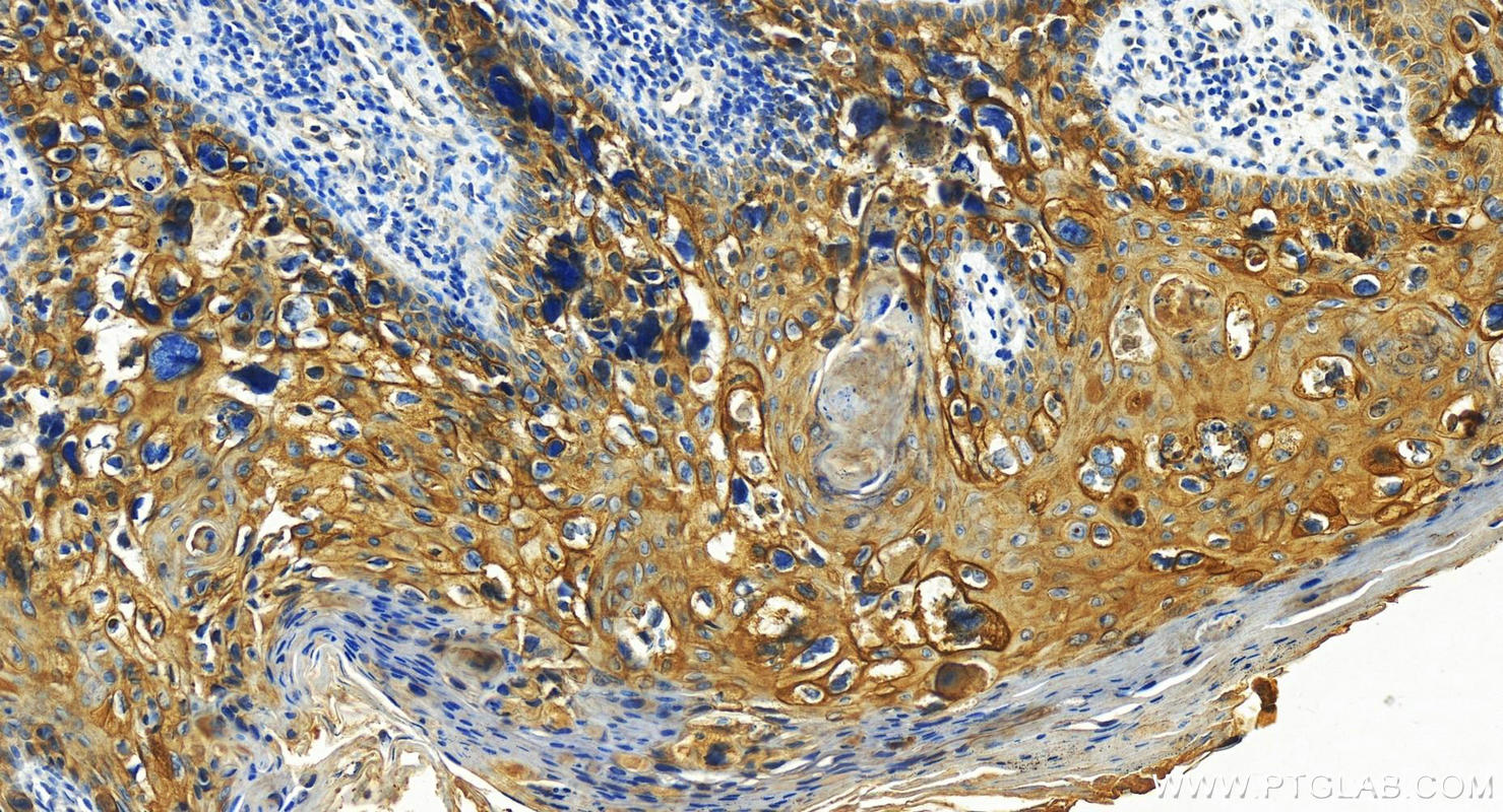 IHC staining of human bowen disease using 25318-1-AP