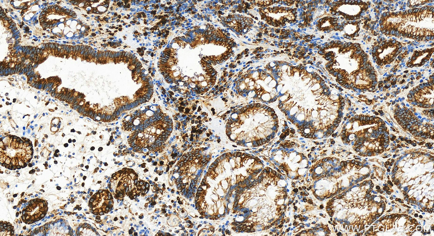 IHC staining of human stomach cancer using 83591-2-RR