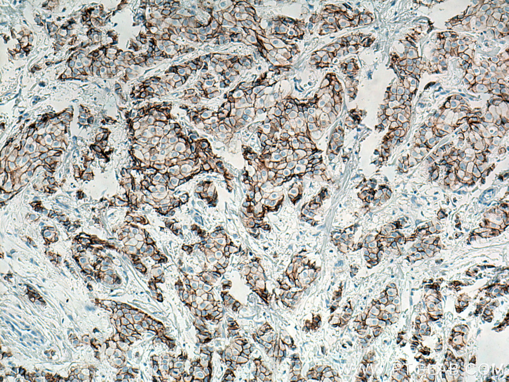 IHC staining of human breast cancer using 60335-1-Ig