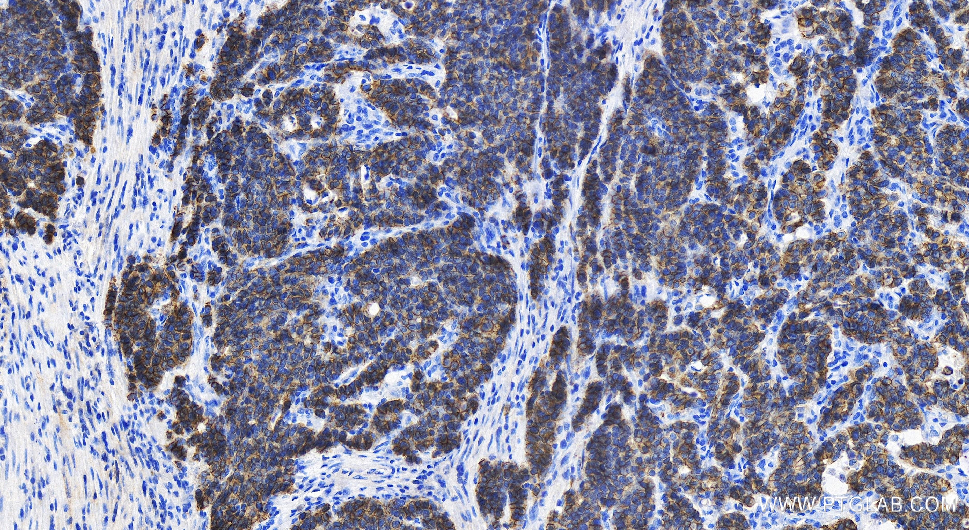 IHC staining of human stomach cancer using 80541-5-RR (same clone as 80541-5-PBS)