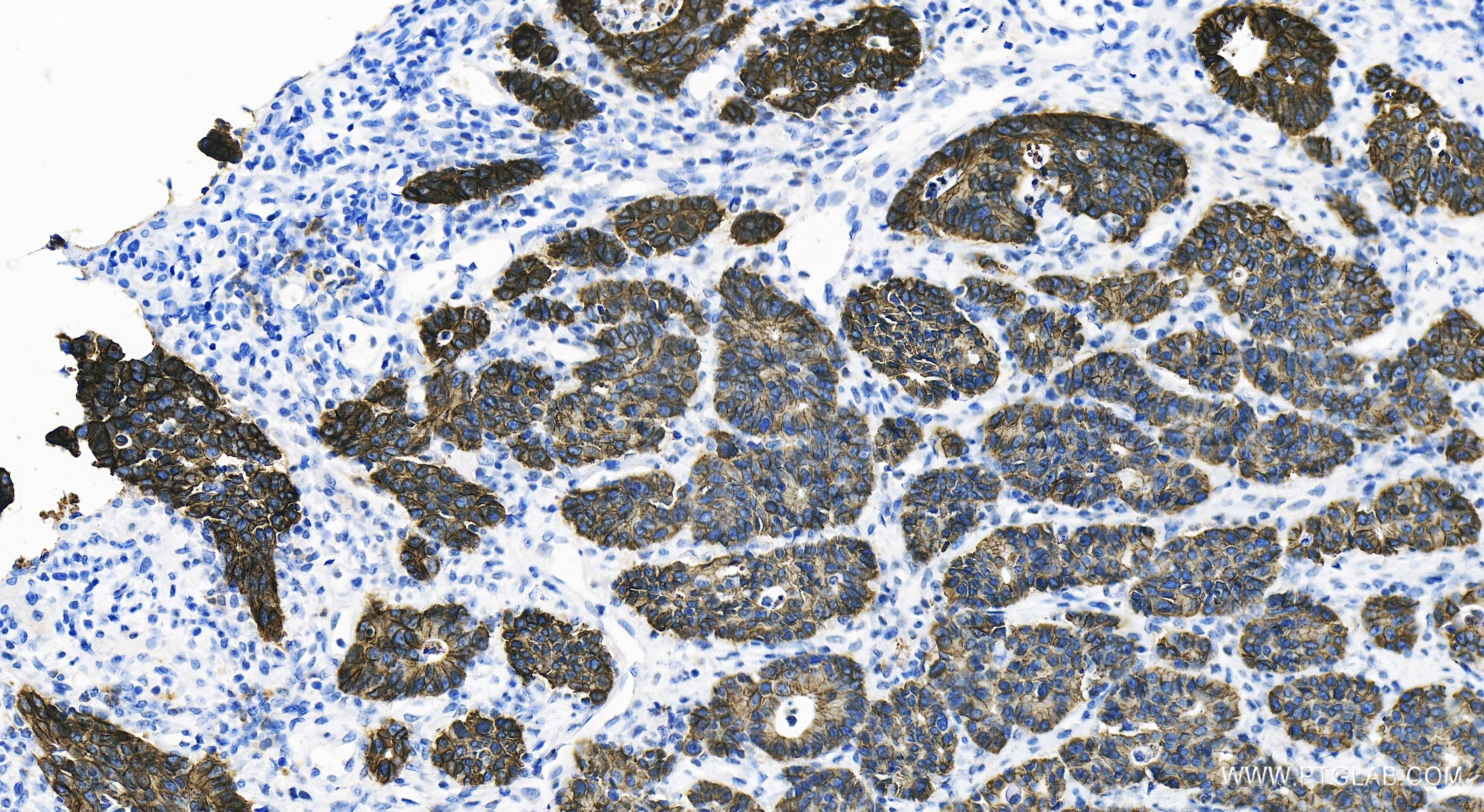 IHC staining of human stomach cancer using 80541-7-RR (same clone as 80541-7-PBS)