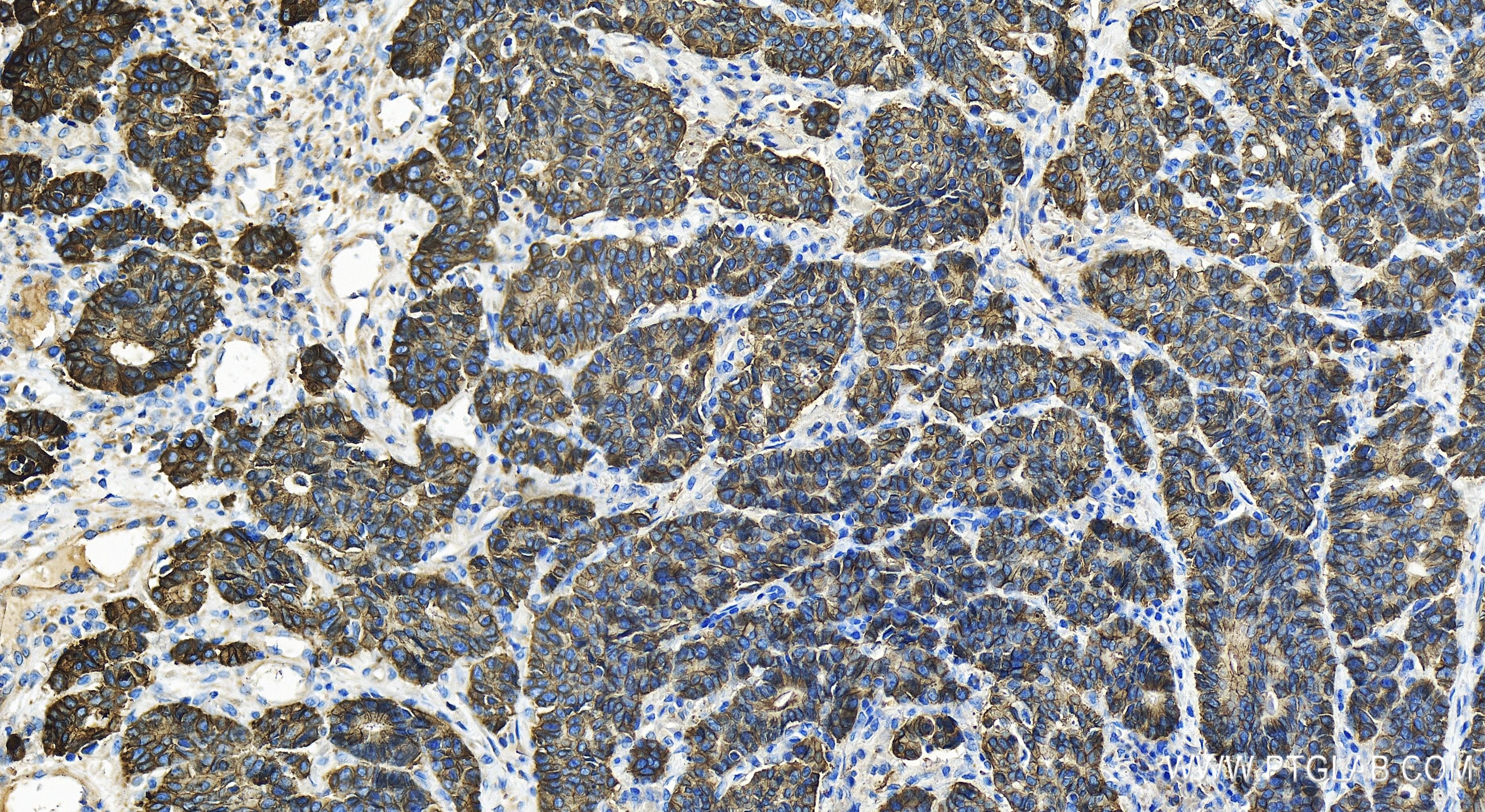 IHC staining of human stomach cancer using 80541-9-RR (same clone as 80541-9-PBS)