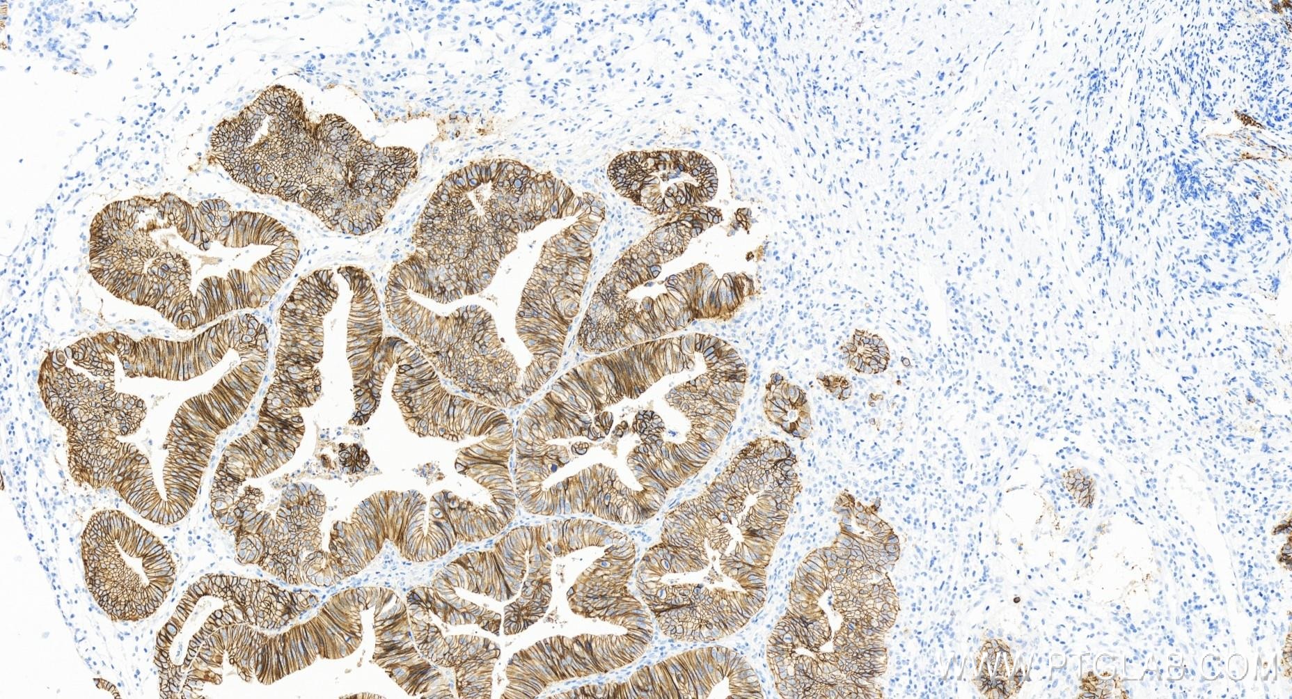 IHC staining of human colon cancer using 83991-4-RR