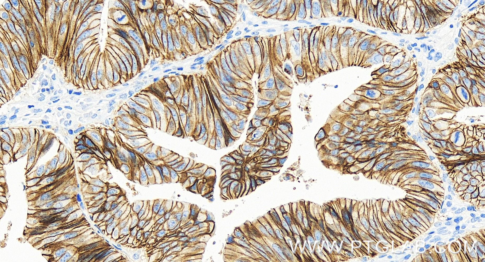 IHC staining of human colon cancer using 83991-4-RR (same clone as 83991-4-PBS)