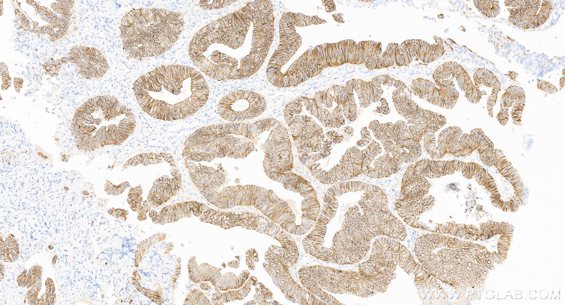 IHC staining of human colon cancer using 83991-4-RR