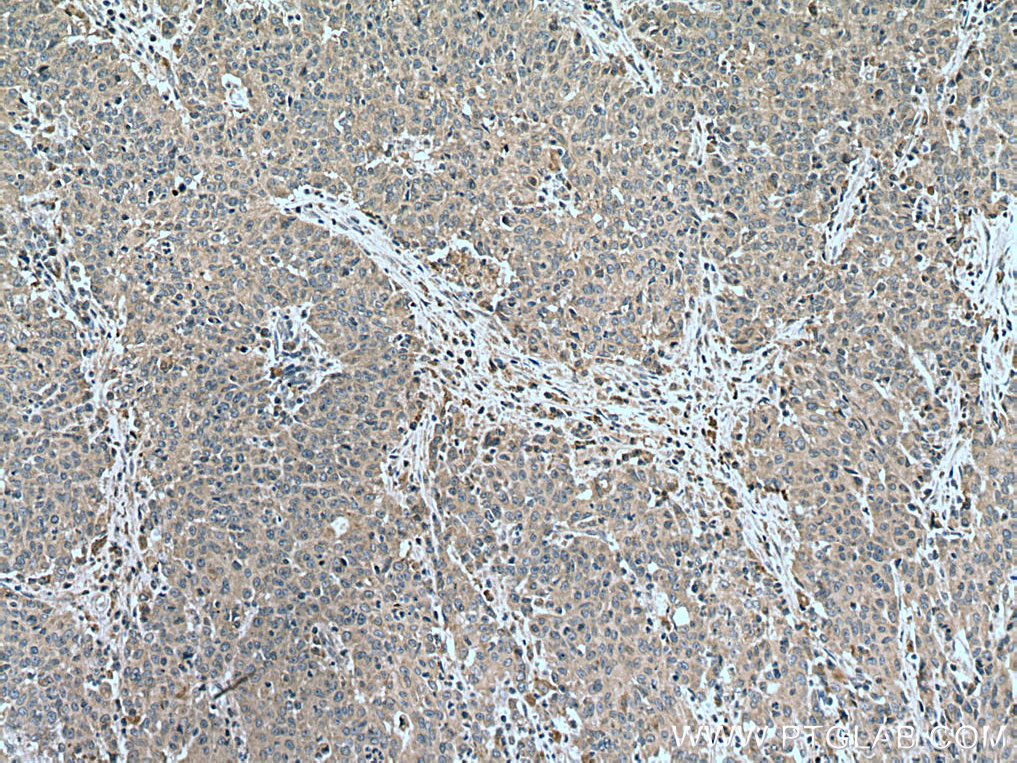 IHC staining of human stomach cancer using 14159-1-AP
