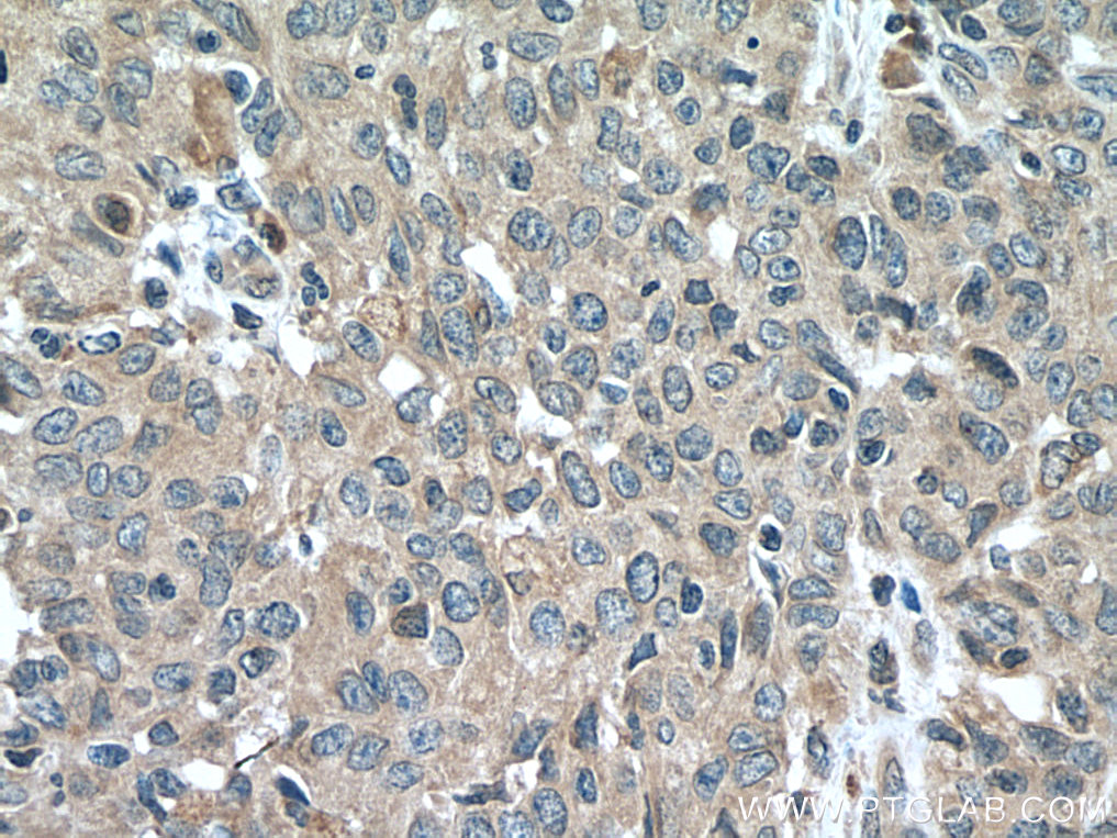 IHC staining of human stomach cancer using 14159-1-AP