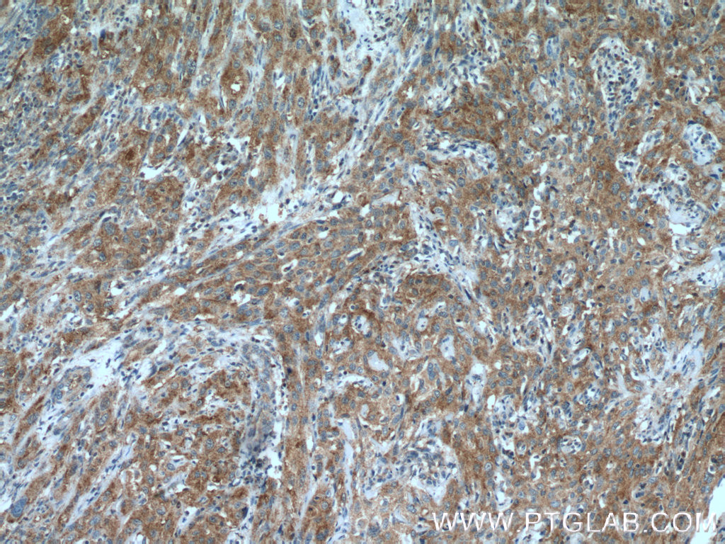 IHC staining of human cervical cancer using 12968-1-AP