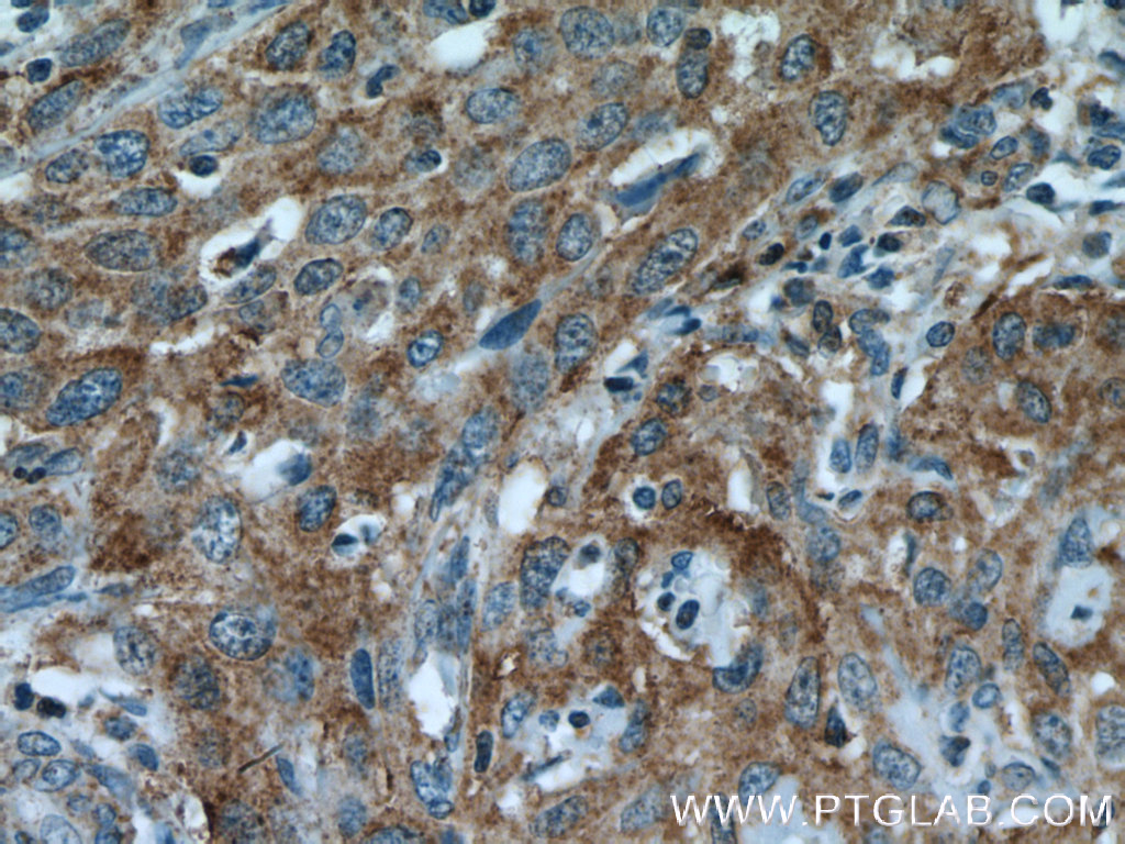 IHC staining of human cervical cancer using 12968-1-AP