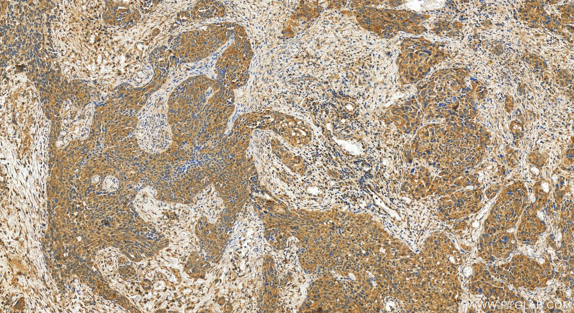 IHC staining of human ovary cancer using 10192-1-AP