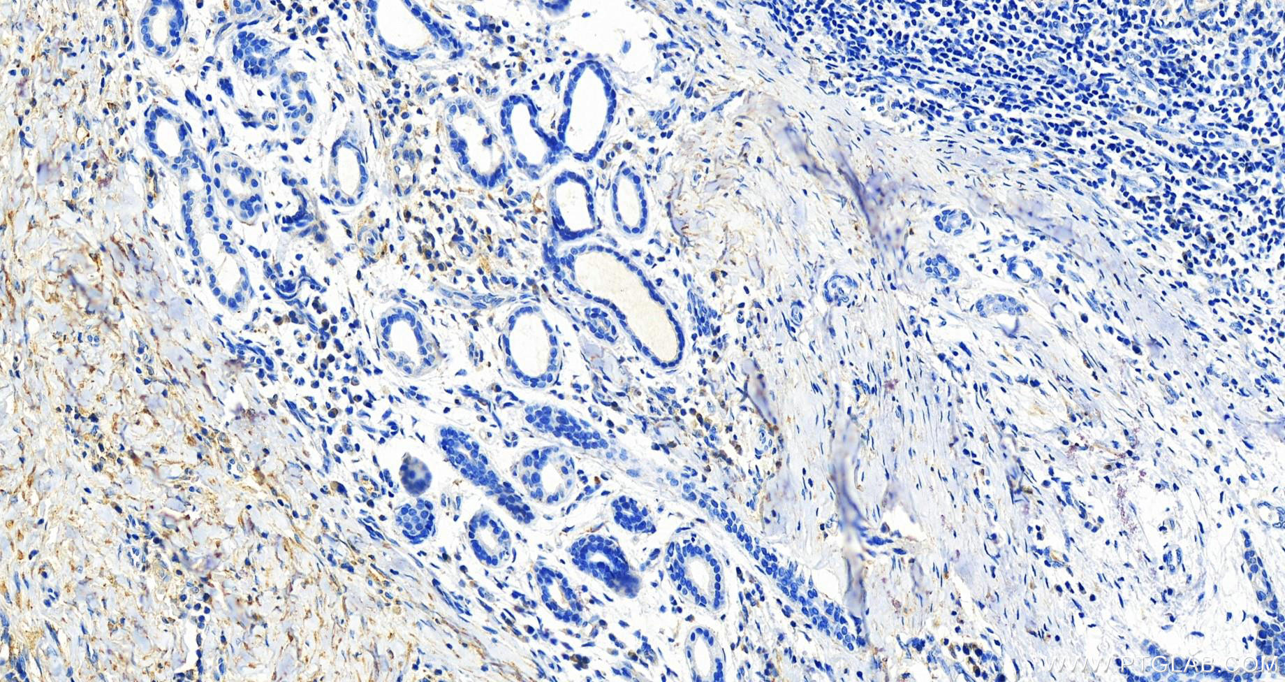 IHC staining of human skin cancer using 68472-1-Ig