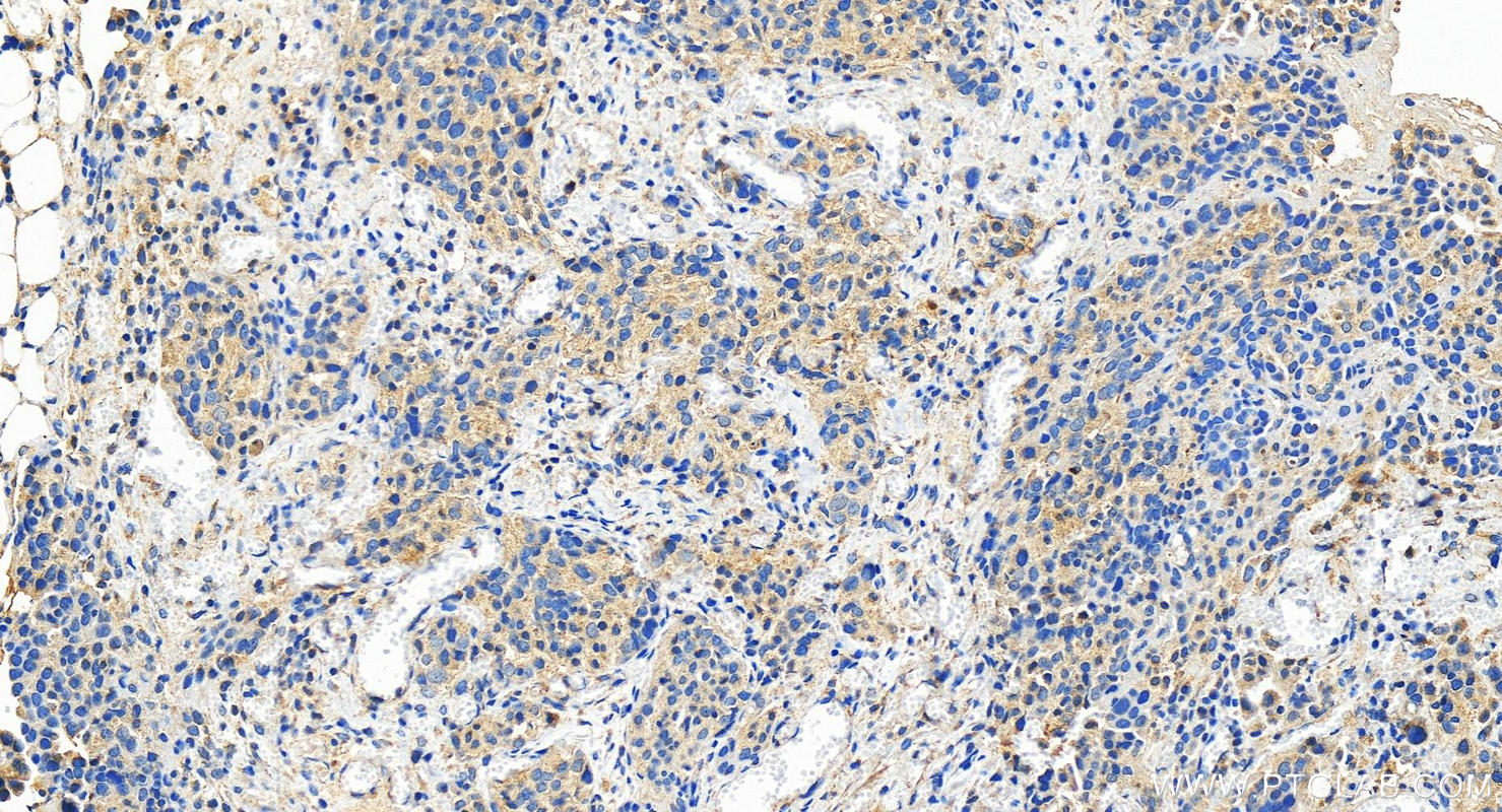 IHC staining of human ovary cancer using 27548-1-AP