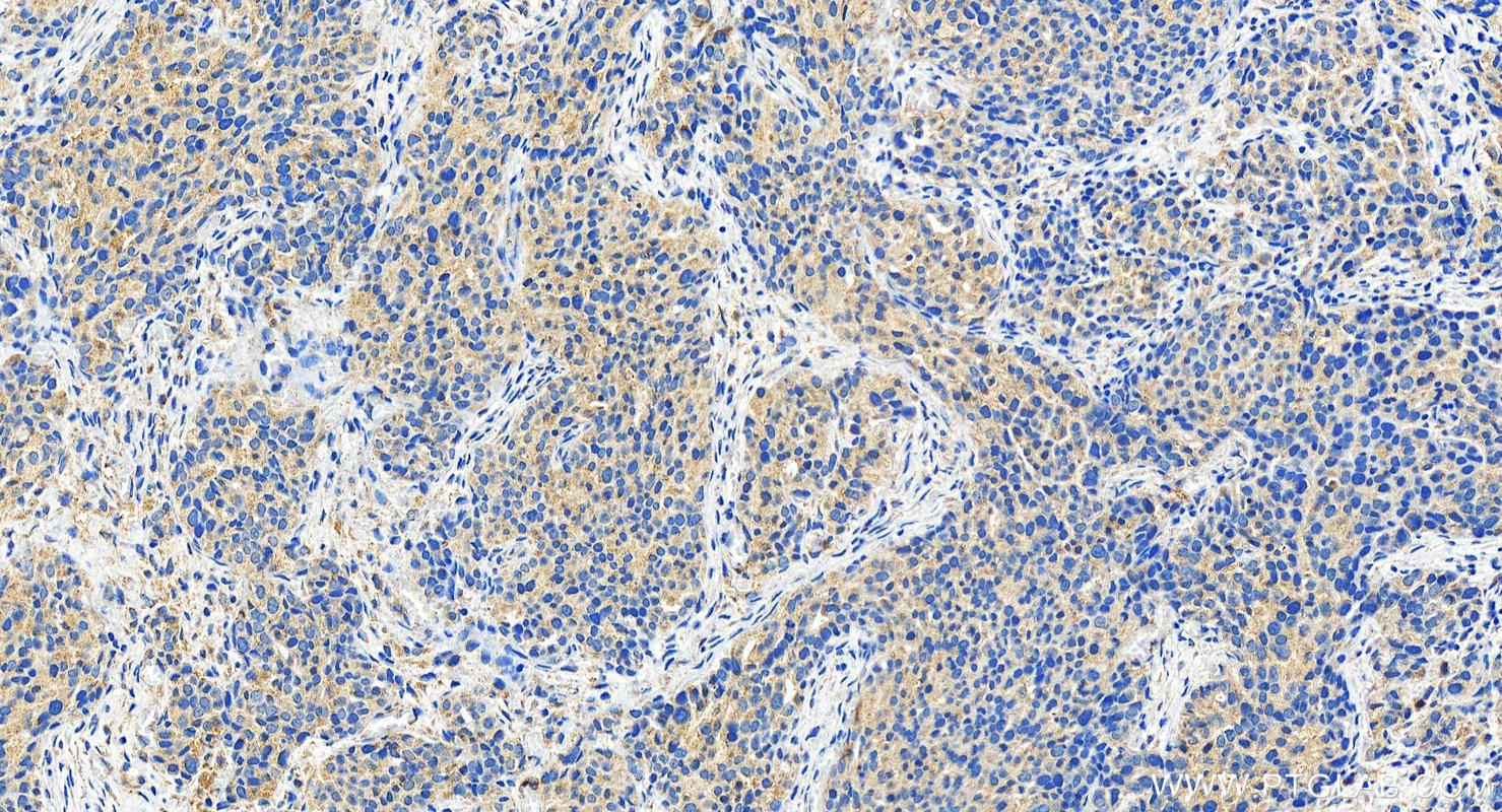 IHC staining of human ovary cancer using 27548-1-AP