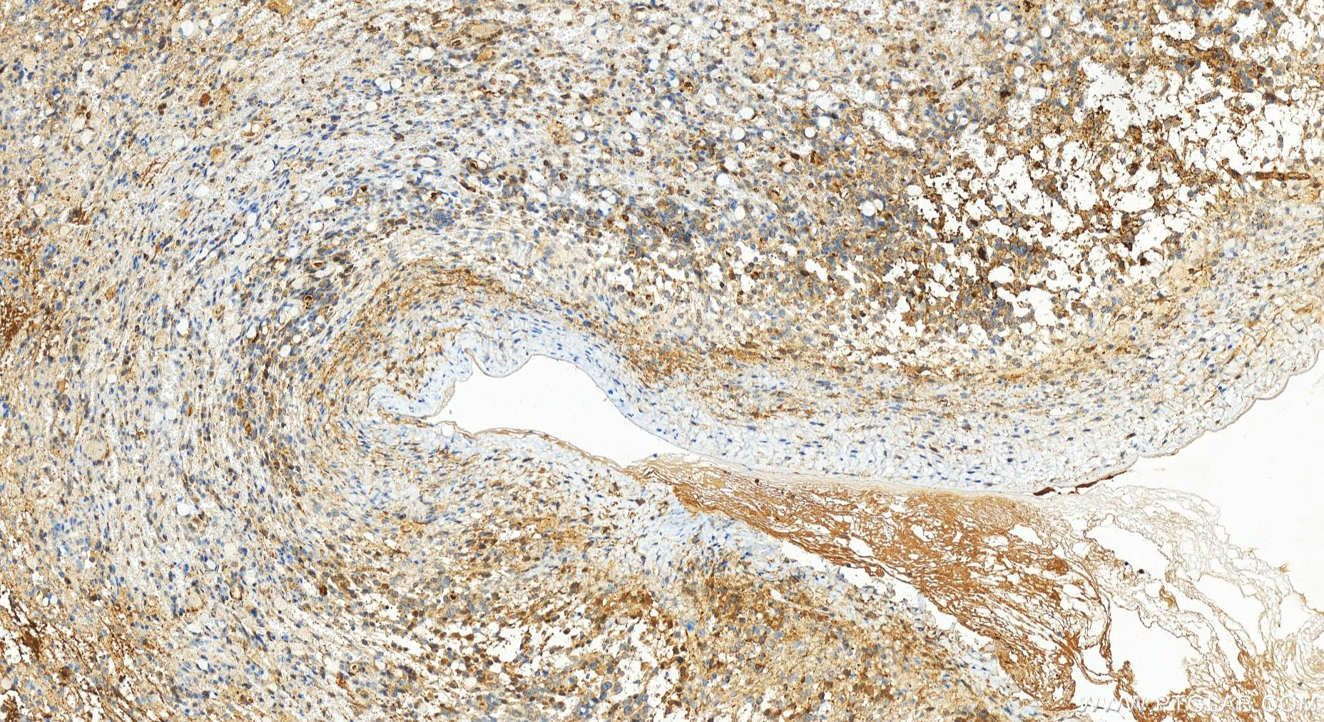 IHC staining of human ovary cancer using 83295-1-RR