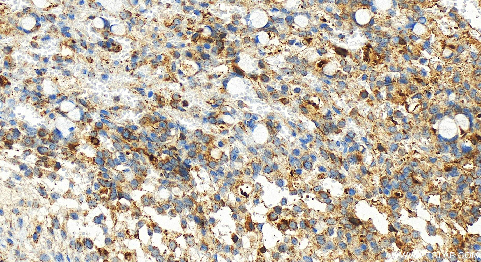 IHC staining of human ovary cancer using 83295-1-RR