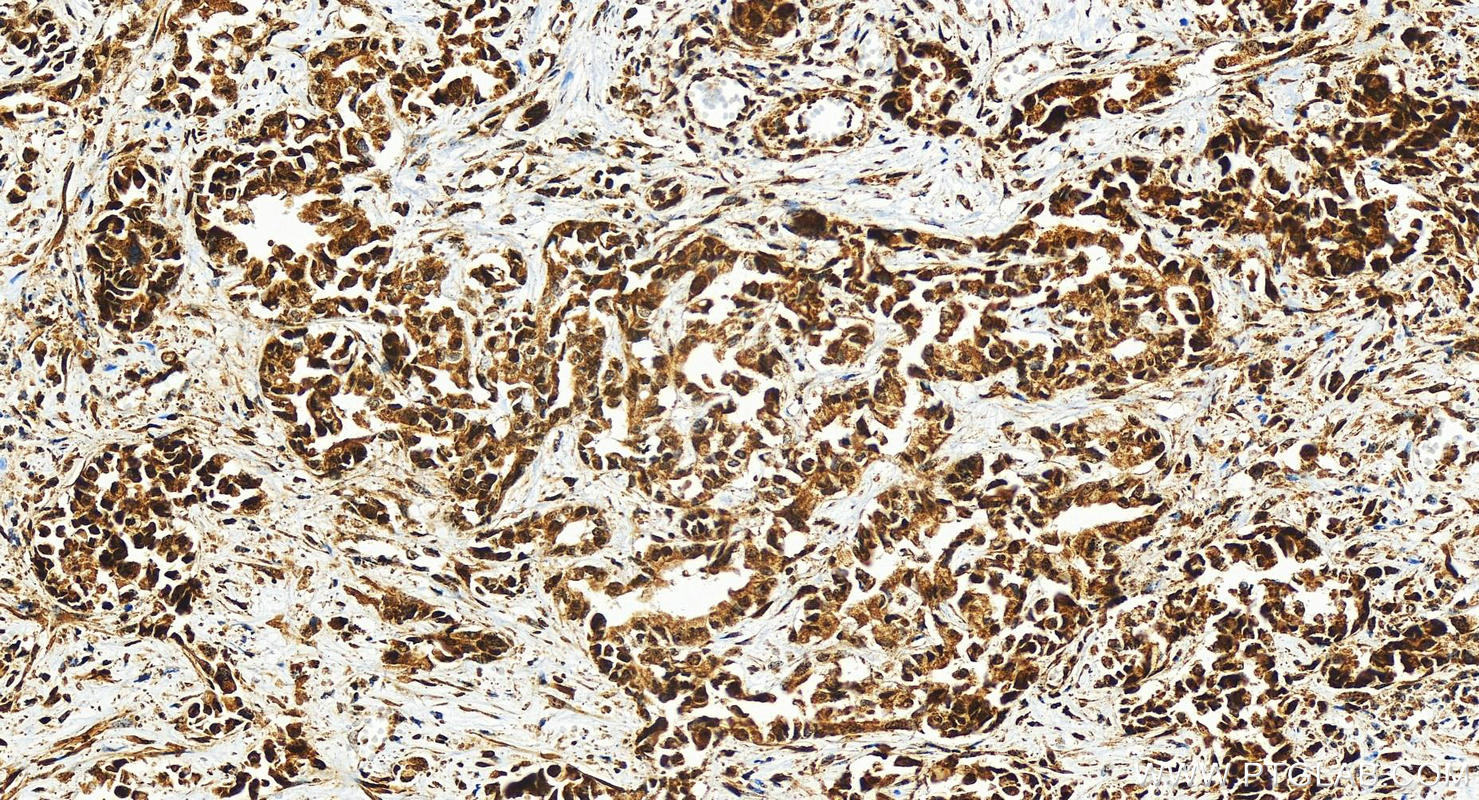 IHC staining of human intrahepatic cholangiocarcinoma using 83295-5-RR (same clone as 83295-5-PBS)