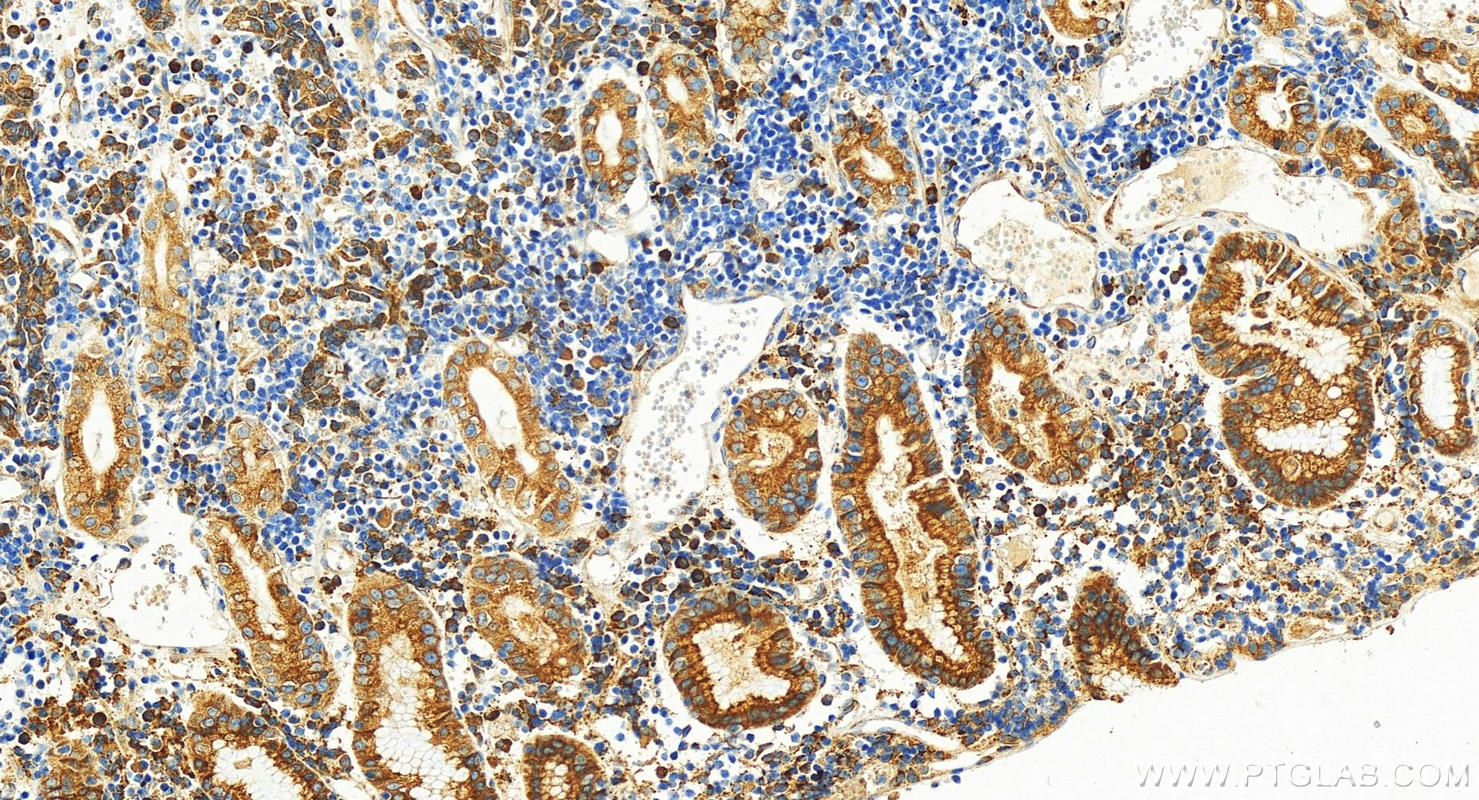 IHC staining of human stomach cancer using 27310-1-AP