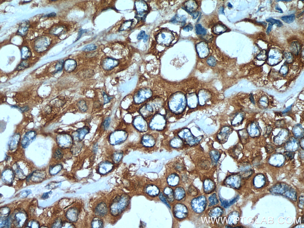 IHC staining of human pancreas cancer using 67495-1-Ig (same clone as 67495-1-PBS)