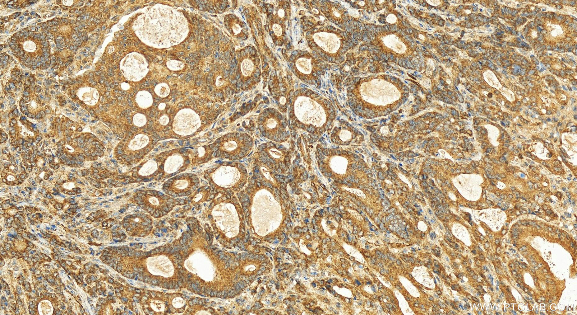 IHC staining of human stomach cancer using 20859-1-AP