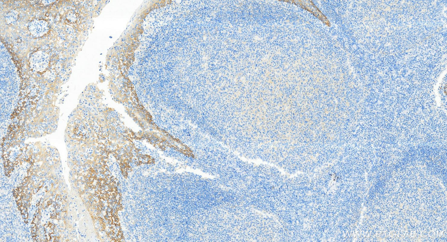 IHC staining of human tonsillitis using 66455-1-Ig