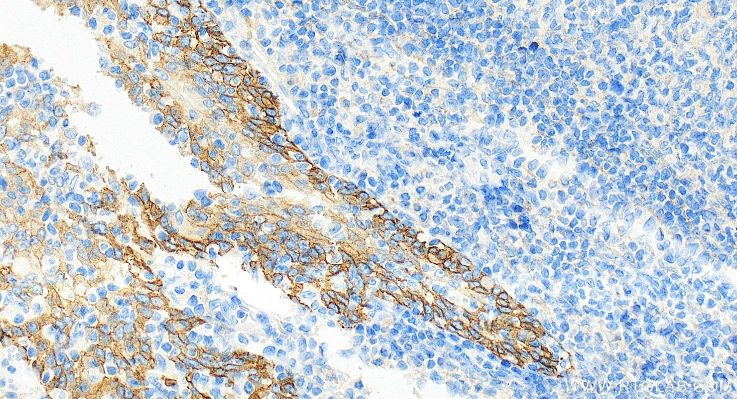 IHC staining of human tonsillitis using 66455-1-Ig