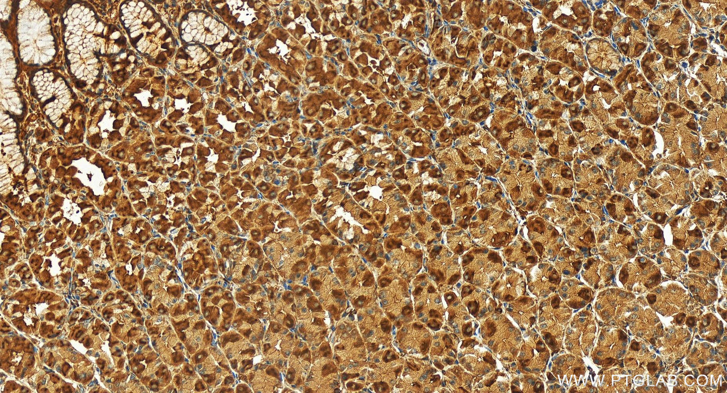 IHC staining of human stomach cancer using 24657-1-AP