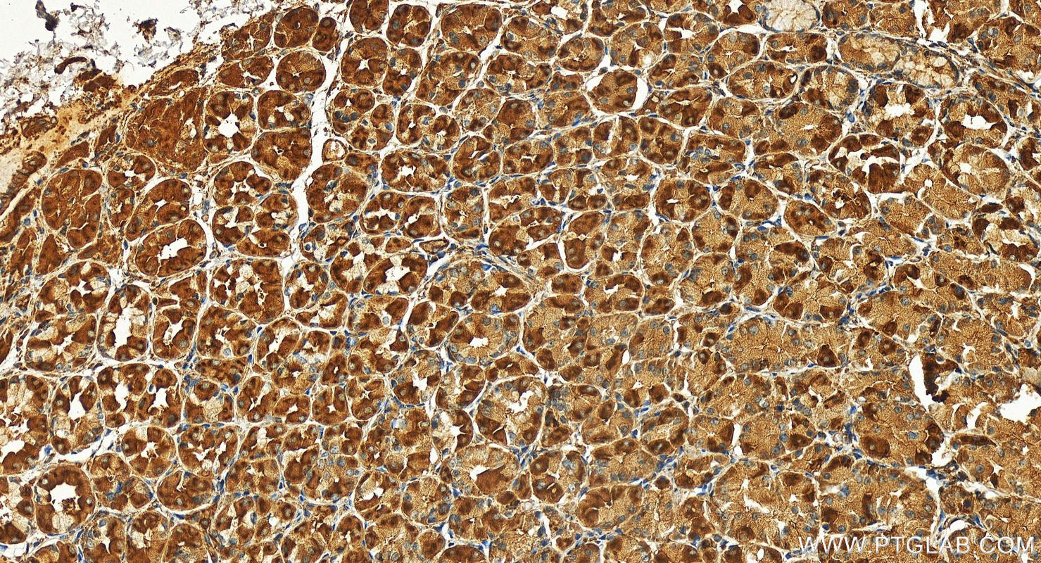 IHC staining of human stomach cancer using 24657-1-AP