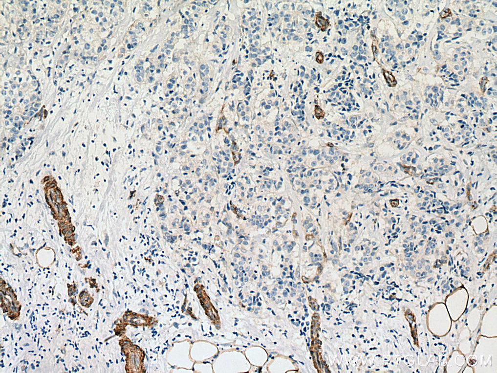 IHC staining of human breast cancer using 11440-1-AP (same clone as 11440-1-PBS)