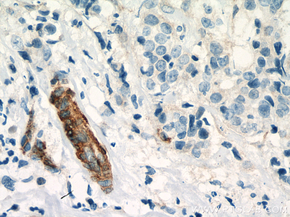 IHC staining of human breast cancer using 11440-1-AP (same clone as 11440-1-PBS)