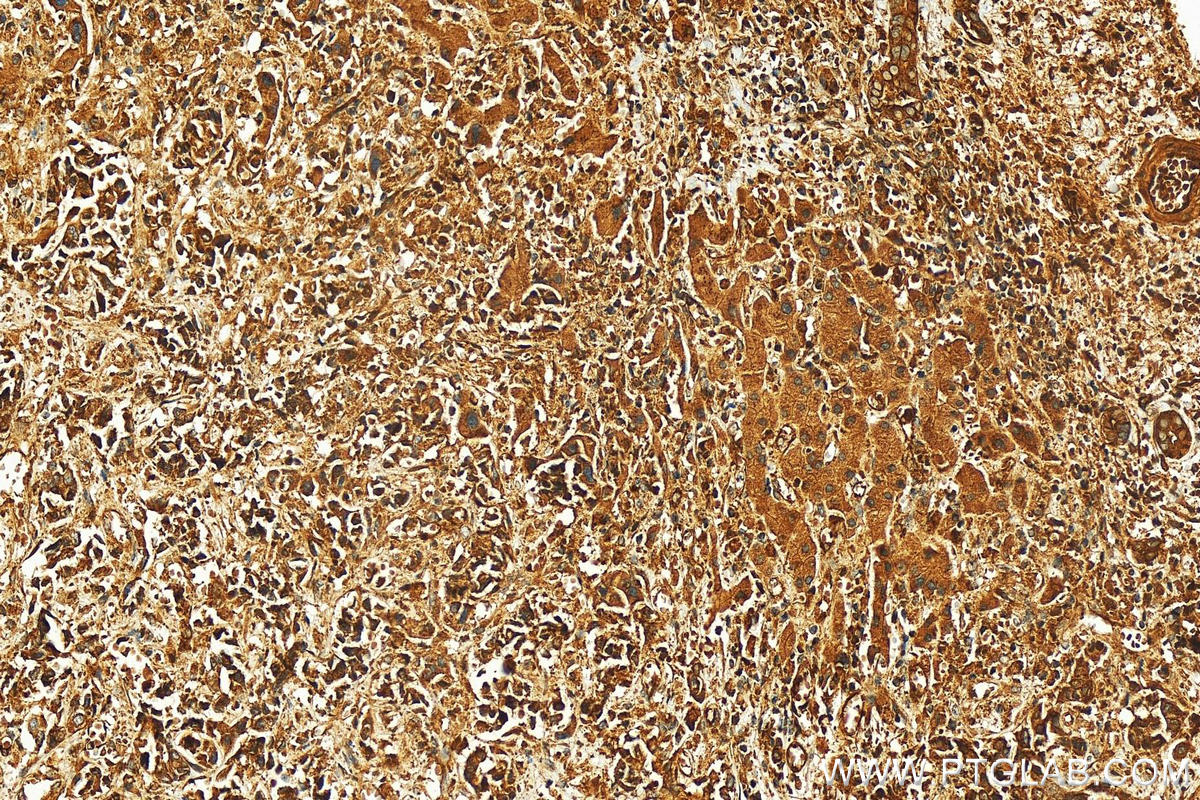 IHC staining of human intrahepatic cholangiocarcinoma using 11382-2-AP