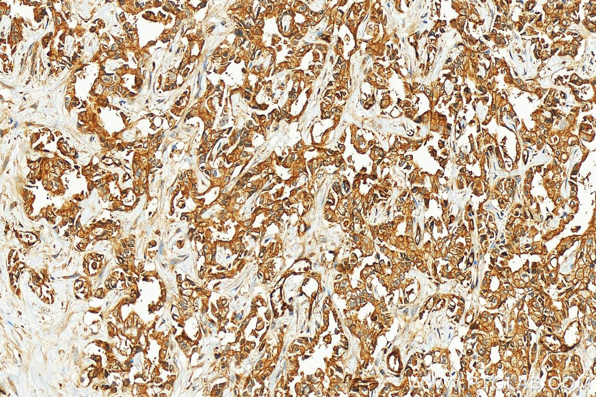 IHC staining of human intrahepatic cholangiocarcinoma using 11382-2-AP