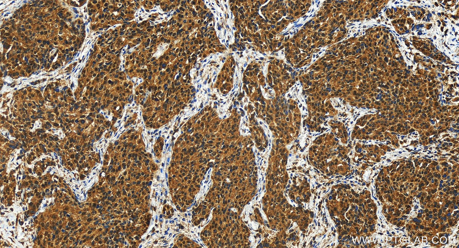 IHC staining of human ovary cancer using 27195-1-AP